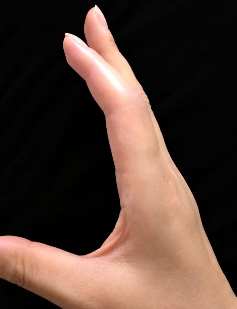 腫れて皮膚が光り、まっすぐ伸びたまま曲がらない右手の人差し指